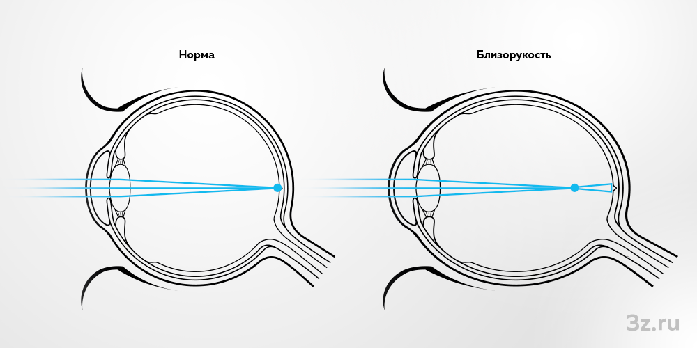 Расположение оптического фокуса изображения при нормальном зрении и при близорукости