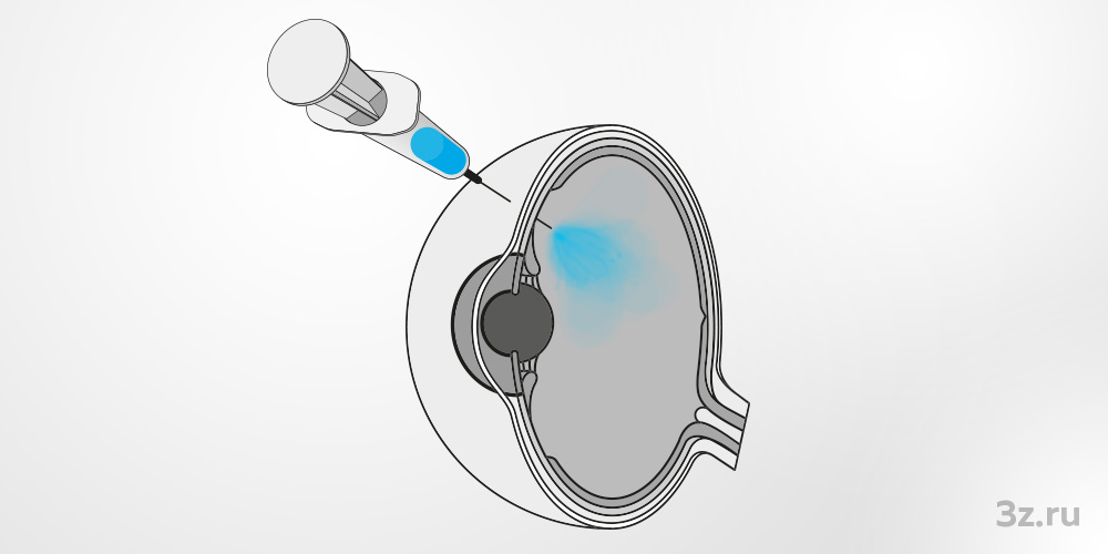 Введение препаратов «Эйлеа» или «Луцентис» в полость стекловидного тела